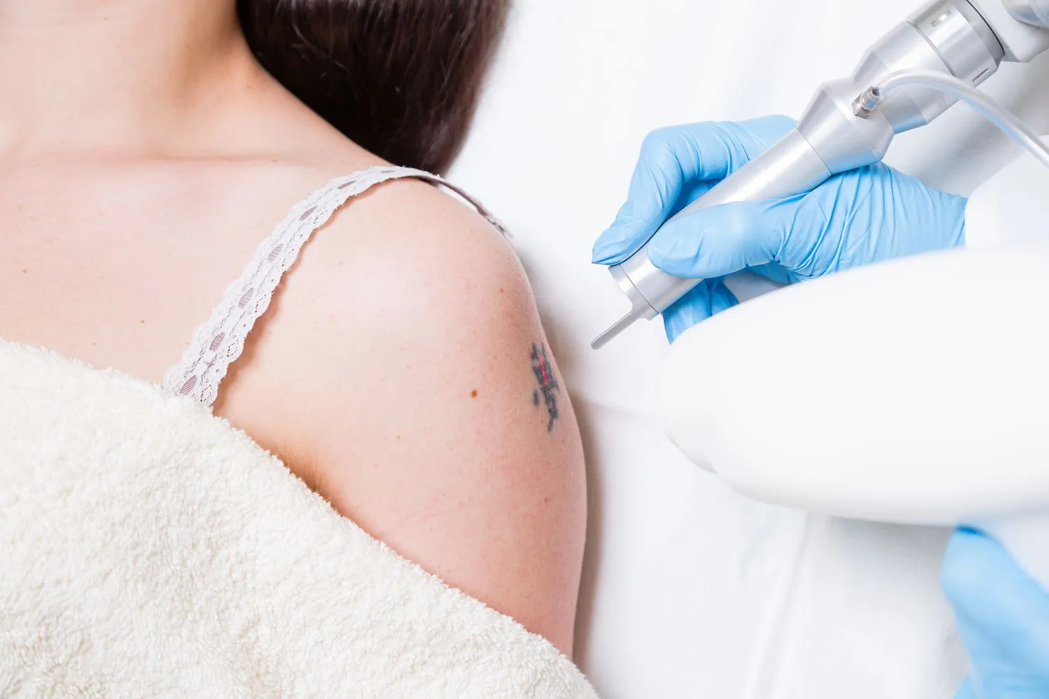 Tattoo removal (Q- Switched Laser)