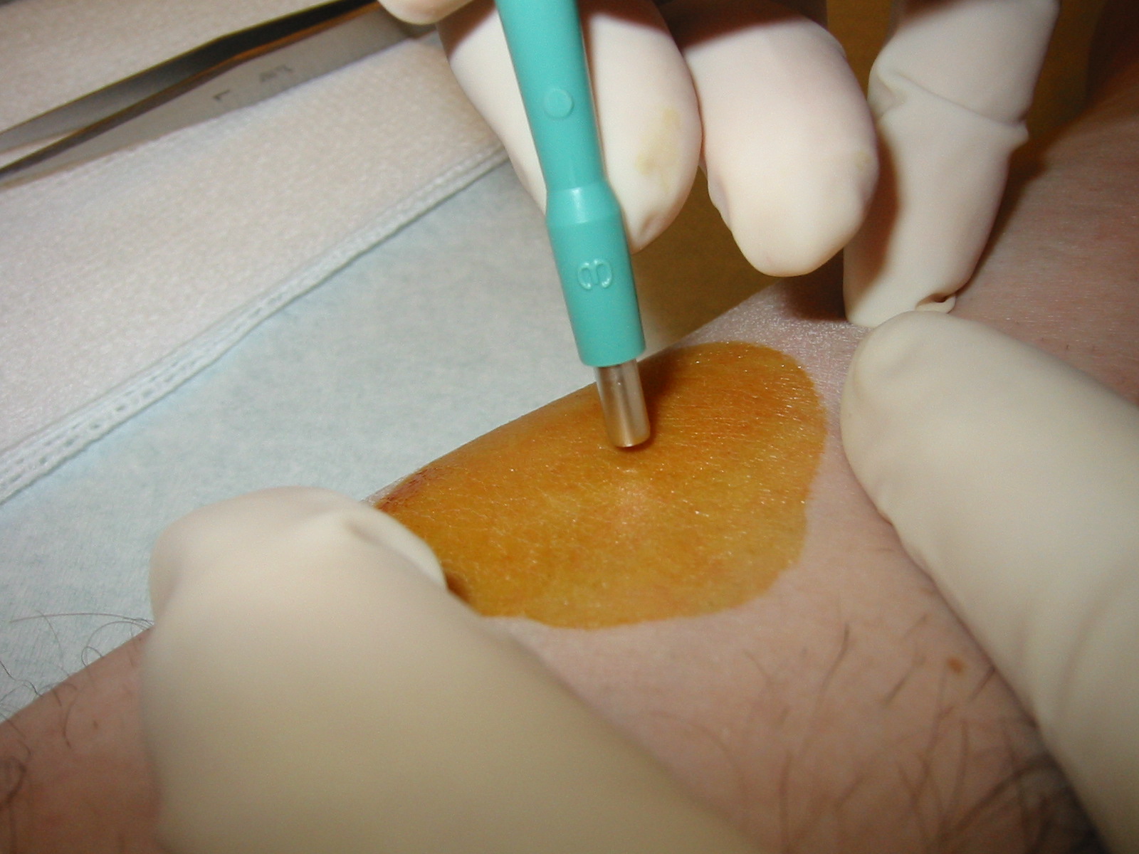 Biopsies: Accurate Diagnosis for Effective Treatment