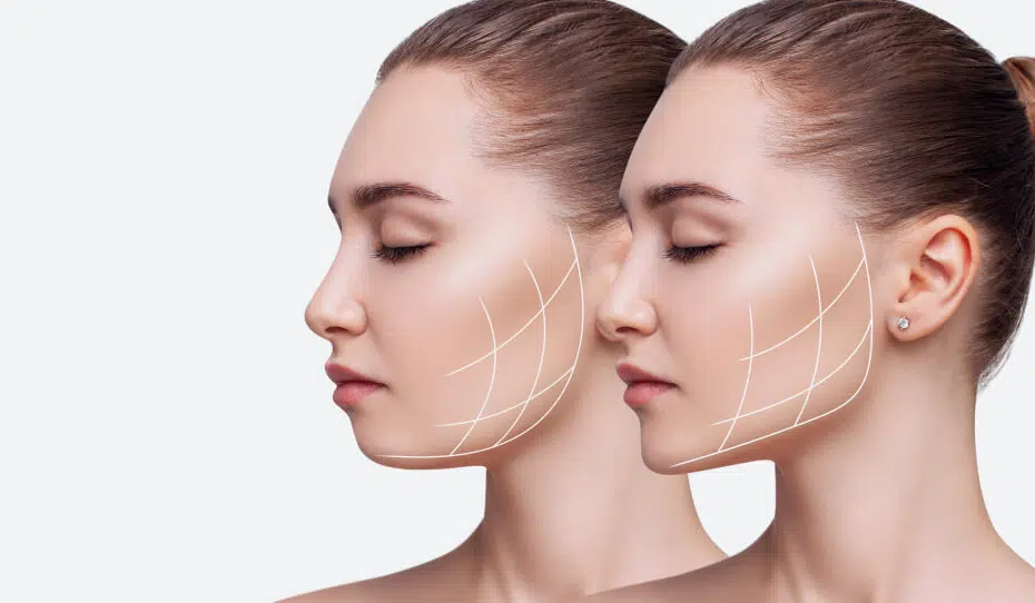 Chin Fillers