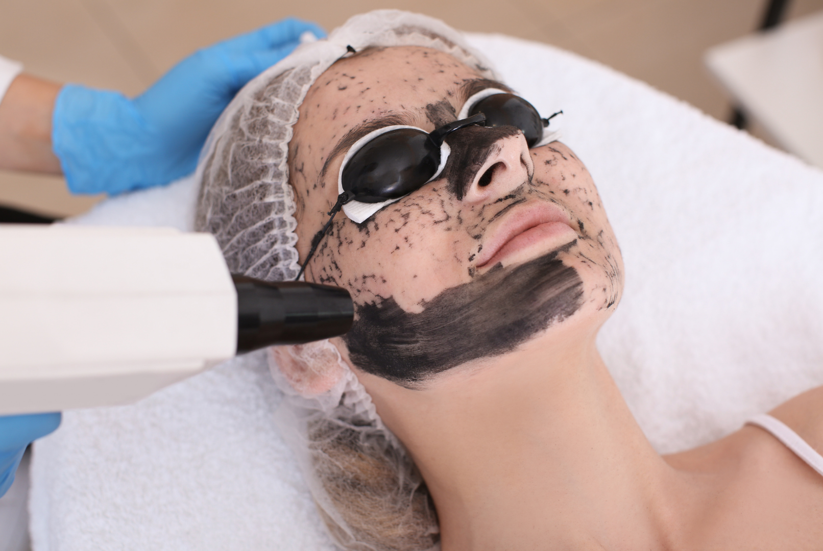 Carbon Q-Switched Laser Peel